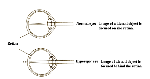 What are the symptoms of Hypermetropia?