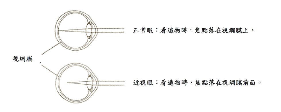 的 近視 病